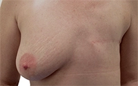 Mastectomy