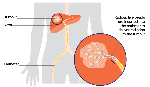 Diagram showing how selective internal radiation is done Selective internal radiation therapy (SIRT) combines embolisation with internal radiation therapy