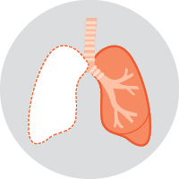 Diagram of a Pneumonectomy - If the cancer is in more than one lobe of a lung, or near where the airways enter the lung, a pneumonectomy may be done. In this operation, a whole lung is removed. It’s possible to still breathe normally with one lung.