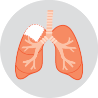 Diagram of Segmentectomy - For some early-stage lung cancers that are on
the edge of the lung, a segmentectomy may be
used. In this operation, a small part of the lobe
is removed.