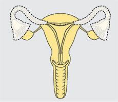 salpingectomy bilateral cervical hysterectomy