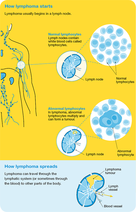 Hodgkin Lymphoma Cancer Council Nsw