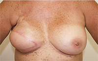 Mastectomy with flap reconstruction