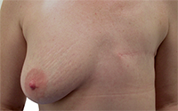 Mastectomy