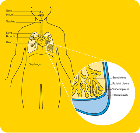 Pleural mesothelioma affects the pleura, the membrane that covers the lungs.