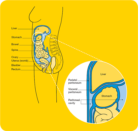 Peritoneal mesothelioma affects the peritoneum, the membrane that lines the walls and covers the organs of the abdomen and pelvis.