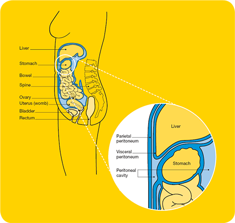 does hpv prevent ovarian cancer