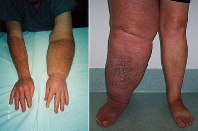 swelling caused by lymphoedema