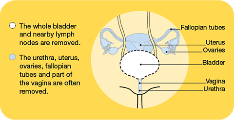 Cystectomy in females