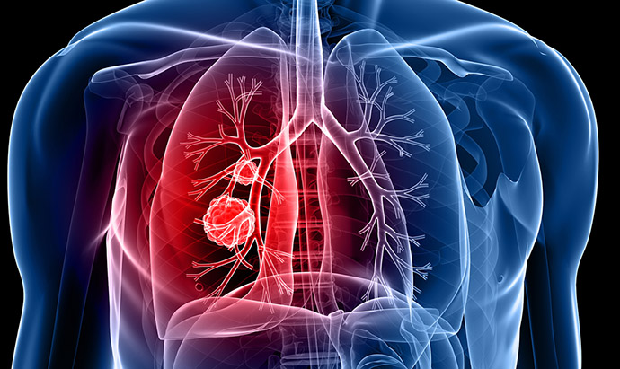 lung cancer