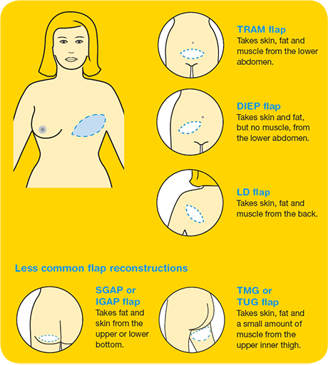 Location of flap reconstruction