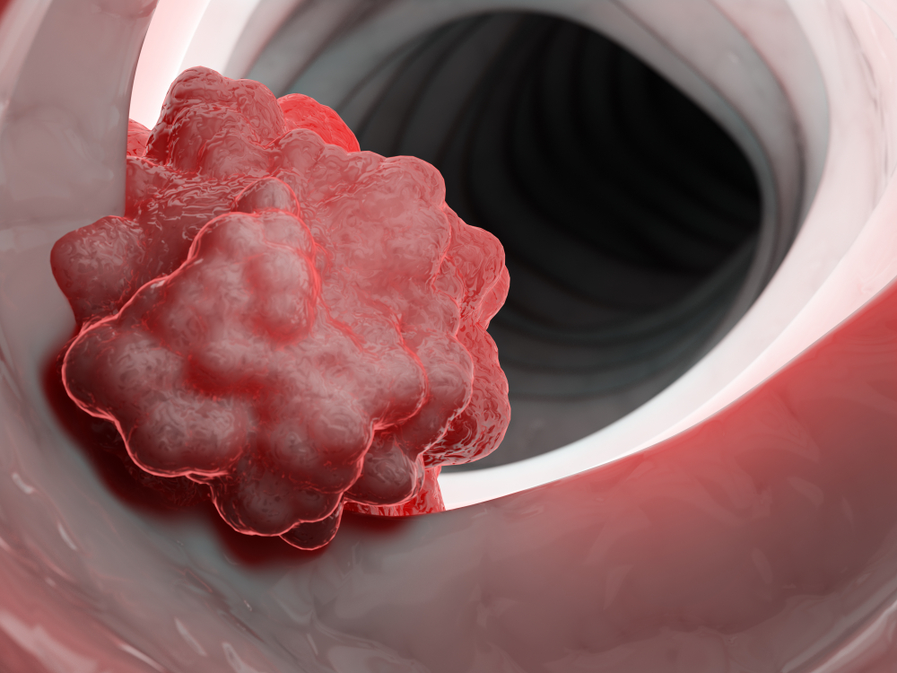 Understanding How Polyps Cause Bowel Cancer Cancer Council NSW