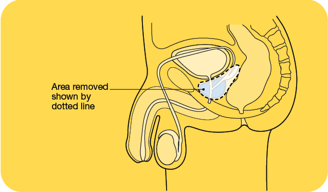 prostate cancer surgery recovery)