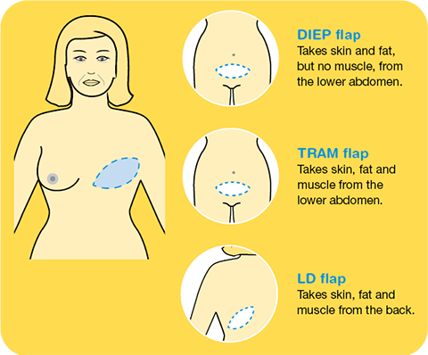 Location of flap reconstruction