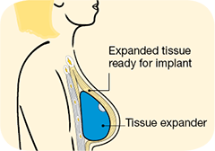 expanding tissue expander