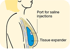 implanting tissue expander