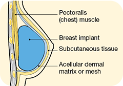 prepectorial implant