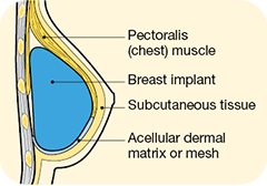 subpectorial implant