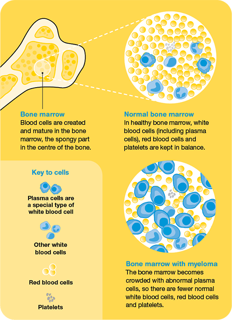 how myeloma starts