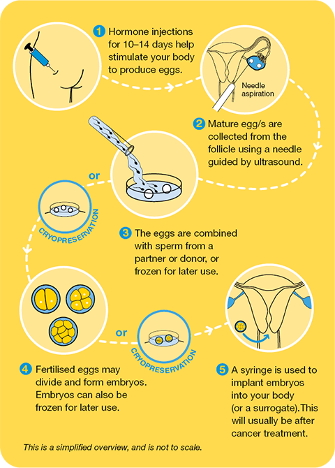 in vitro fertlisation process