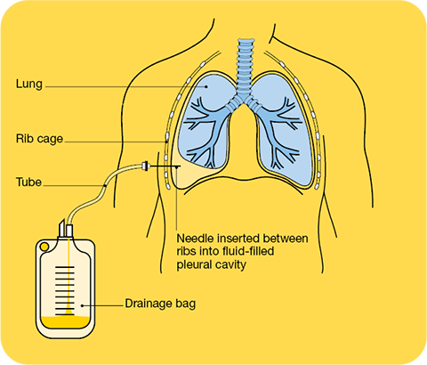 Breathlessness | Lung Cancer | Cancer Council Nsw