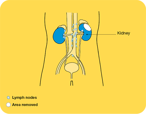 Image of a partial nephrectomy