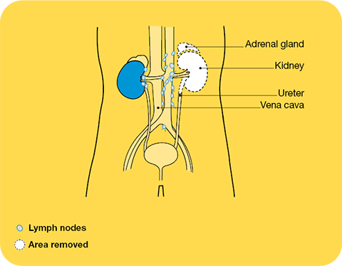 Image of a radical nephrectomy