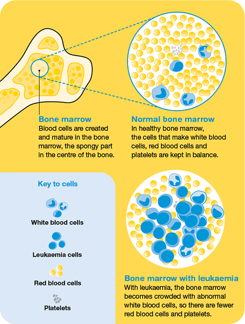 How leukaemia starts in the bone marrow