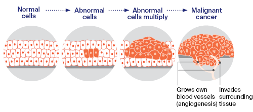 Diagram: How cancer starts