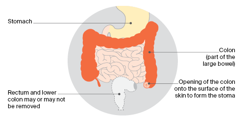 Colostomy