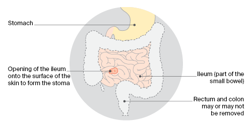 Illeostomy