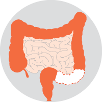 Sigmoid colectomy