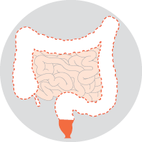 Subtotal or total colectomy