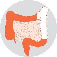 left hemicolectomy