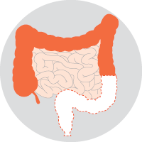 Abdominoperineal resection or excision (APR or APE)