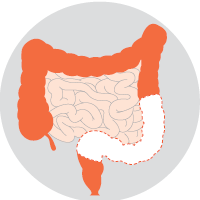 High Anterior resection