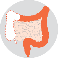 right hemicolectomy