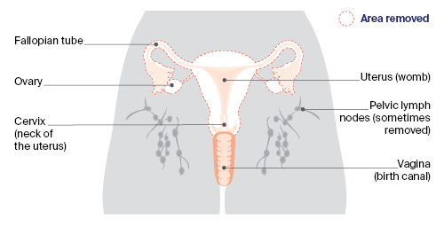 different types of uterine cancer