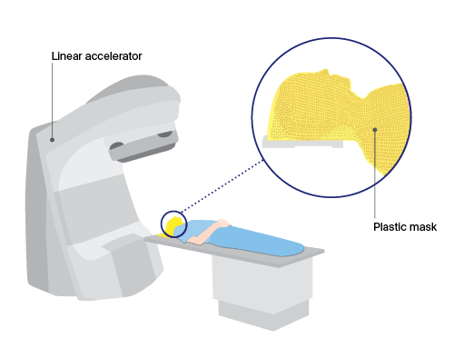 External radiation therapy