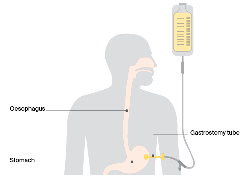 feeding tube in stomach life expectancy