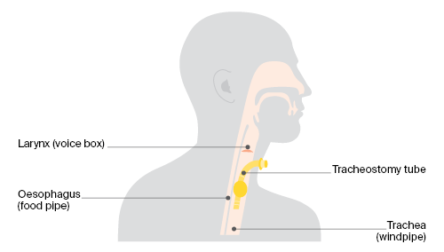 Tracheostomy