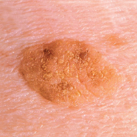 The Signs Of Skin Cancer Cancer Council Nsw