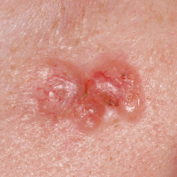 The Signs of Skin Cancer | Council NSW