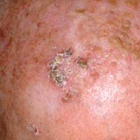 Squamous cell carcinoma (SCC)