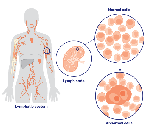 How lymphoma starts and spreads