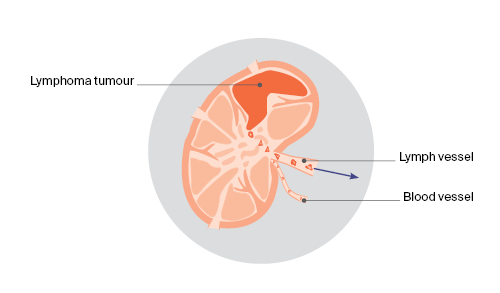 How lymphoma spreads