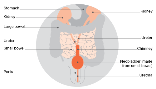 This method of collecting urine creates a pouch that works the same way as the bladder. This pouch is called a neobladder, and it allows you to urinate as usual.