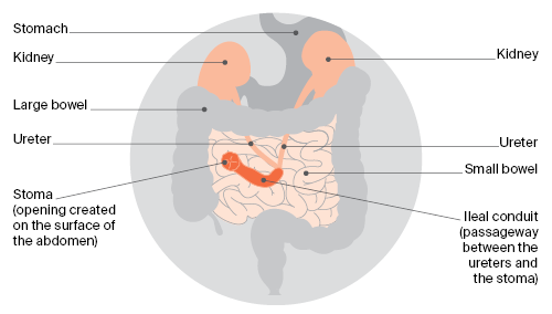 Diagram: A urostomy is the most common type of urinary diversion. Also known as an ileal conduit, a urostomy means that urine will drain into a bag attached to the outside of the abdomen.