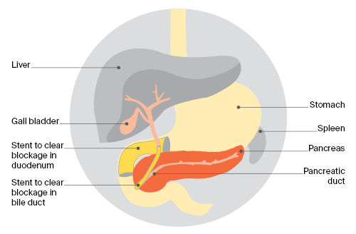 Inserting a stent 