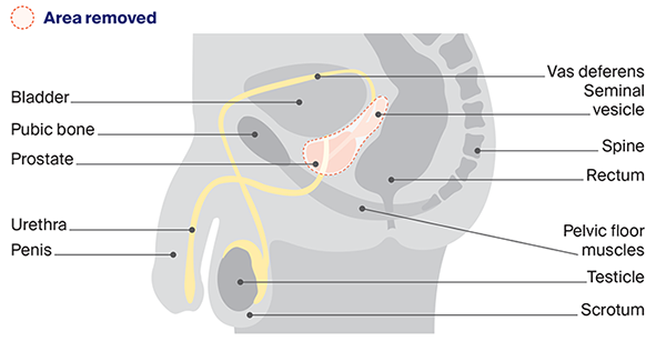 Diagram showing the area removed (the prostate, part of the urethra and the seminal vesicles) during a radical prostatectomy. 